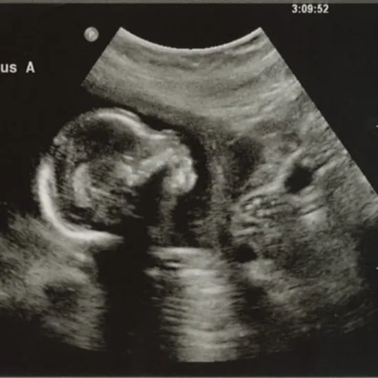 Ultrasound Level-II-Twins Test
